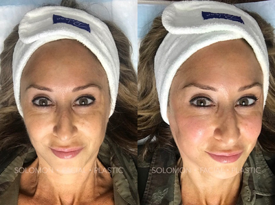 48 year old woman treated with Forma - This 48 year old female patient was treated with the Forma Facial in Toronto. The radio-frequency treatment was used to target fine lines around her eyes and mouth while also tightening the skin beneath the chin, the jowls and cheek area resulting in a lifted appearance. Post-Treatment Image is immediately following the treatment.