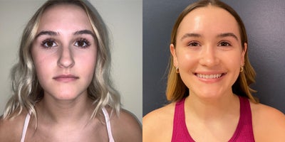 25-34 year old woman treated with Rhinoplasty, Septoplasty - Primary Preservation Hybrid Septorhinoplasty