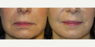 60 year old woman treated with Laser Resurfacing - 60 year old female treated with CO2 laser resurfacing to treat the upper lip vertical fine wrinkles. Note the nice improvement in these lines.