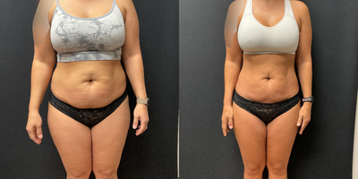 35-44 year old woman treated with Ozempic for Weight Loss - Patient has lost 30lbs in 6 months on the Skinny Shot (Semaglutide)