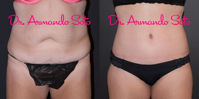 45-54 year old woman treated with Butt Lift - This lovely 50 year old woman wanted to look as good as she felt she deserved to look after a large weight loss. She underwent a Lower Body Lift at Aesthetic Enhancements Plastic Surgery in Orlando with Dr. Armando Soto and is exceedingly pleased with the outcome achieved. She is shown before and only a few months after surgery (shape will continue to improve and scars will fade for another year).bu