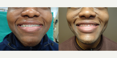 18-24 year old man treated with Dimple Surgery - Timeless Dimple, Dimple Creation