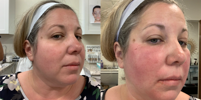 35-44 year old woman treated with Pelleve - Vampire facelift with PRP and HA Filler