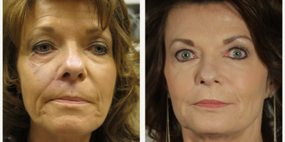 45-54 year old woman treated with Juvederm - 54 year old female with Juvederm Ultra, Ultra Plus, & Voluma