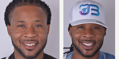 25-34 year old man treated with Lumineers - 20 Porcelain Veneers color Bleach 2, texture and digital design.