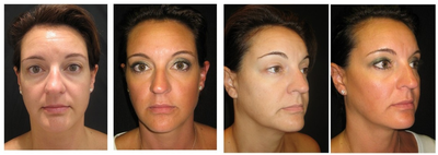 Ultherapy - 