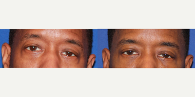 45-54 year old man treated with Belotero - 53 yo male complaining of looking tired. Here he is after one syringe of Belotero and Botox to his upper face.&nbsp;