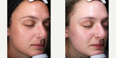 18-24 year old woman treated with Clear and Brilliant - Clear + Brilliant and Permea can help in improving the appearance of sun damage or unwanted brown spots in the skin, reduce pore size, reduce the appearance of fine lines, and improve overall tone and texture. The treatment is not as deep or as invasive as others, but with a series of four treatments it can produce more healthy glowing skin with less downtime than the deeper more invasive procedures. In addition to healthier skin due to cell turnover caused by the microscopic injuries, products will absorb more deeply into the skin through those channels of injury and the products will be more effective throughout the series.