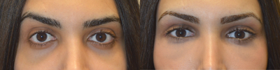 27 Year Old Eyelid Retraction Repair - 27 year old transgender female, underwent eye transformation almond eye surgery including lower eyelid retraction surgery with canthoplasty, infraorbital rim silicone implant, orbital decompression bulging eye surgery, and upper eyelid filler injection. Before and 1 month after surgery photos are shown.