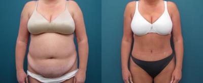 Tummy Tuck - 
	Tummy Tuck with liposuction of the hips.
