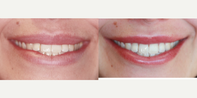 25-34 year old woman treated with Zoom Whitening - This patient was looking for a whiter teeth. Zoom Whitening helped to achieve her goal inexpensively.