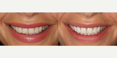 25-34 year old woman treated with Zoom Whitening - This patient wanted to brighten her smile. Zoom Whitening can do it within an hour!