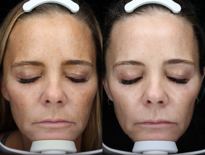 35-44 year old woman treated with Clear and Brilliant - Patient had 2 clear and brilliants done within 3 months to correct skin tone