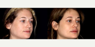 29 year old woman treated with Rhinoplasty, Voluma, Juvederm - 29 year old woman treated with rhinoplasty, 1 syringe of Voluma to cheeks, 1.5 syringe of Juvederm Ultra CX to lips and 0.5 syringe of Juvederm Ultra XC to nasalabial folds. Photos depict before and 3 months after treatment.