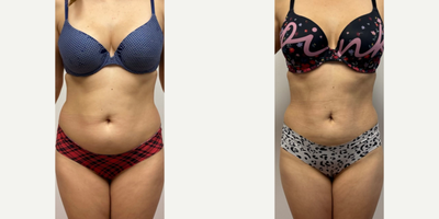 Liposuction - 6 months after liposuction abdomen and hips.