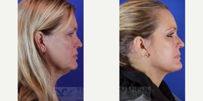 45-54 year old woman treated with Laser Resurfacing, Facelift, Facial Fat Transfer - Procedures PerformedFat TransferCO2 Laser Skin ResurfacingFacelift / Reflection LiftAbout This PatientAge: 51