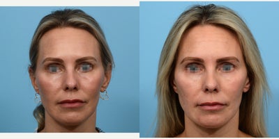 45-54 year old woman treated with Belotero for tear trough - 45-54 year old woman treated with Belotero for tear trough