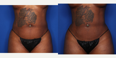 35-44 year old woman treated with BodyTite, Liposuction - 43 y/o female shown 3 months after BodyTite lipo to her abdomen and traditional liposuction to her flanks and bra rolls (lipo 360). She had 2.8 L removed.