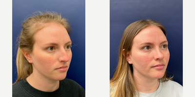 25-34 year old woman treated with Rhinoplasty - 6 weeks post-op Rhinoplasty by Dr. Butler