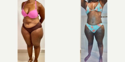 35-44 year old woman treated with Liposuction, BodyTite - 35-44 year old woman treated with Liposuction, BodyTite