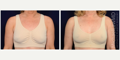 45-54 year old woman treated with Natrelle Breast Implants - Breast augmentation. Follow-up photos are taken 8 months after the procedure.