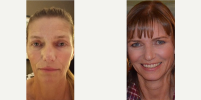 Microneedling - After 10 Combination treatments of MicroNeedling and ND YAG Treatments