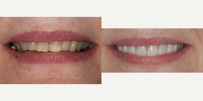 55-64 year old woman treated with Da Vinci Veneers, Porcelain Veneers - Female patient with a desire to change her smile, she was tired of discolored teeth and wanted to have a bright, better looking smile. We went ahead and completed our protocol utilizing our digital smile design software, she was happy with her proposal and our ceramist completed amazing results that transformed her smile just how she wanted. She is extremely happy with her results, we met and exceeded her expectations.