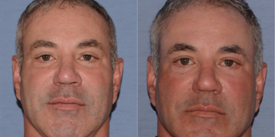 J-Plasma Helium Based Facial Resurfacing - Male J-Plasma facial rejuvenation resurfacing of spots, wrinkles and different pigments