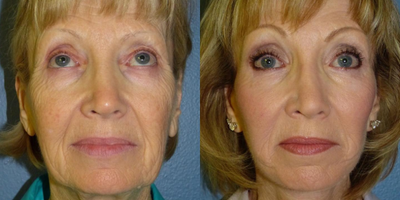 71 year old woman treated with Fractional Laser - 71 year old woman treated with CO2 Laser as well as SMAS Facelift, Neck Lift, and Facial Fat Transfer to treat laxity, volume depletion, and texture for overall facial rejuvenation. She is shown before and 6 months post op.