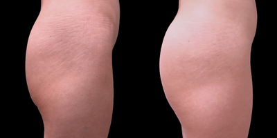 25-34 year old woman treated with Nonsurgical Butt Lift - non-surgical butt lift