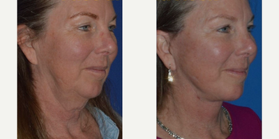 Woman treated with Neck Lift - Woman treated with Neck Lift.