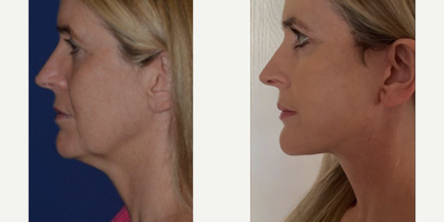Woman treated with Necklift - Woman treated with Facelift.