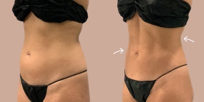 45-54 year old woman treated with AirSculpt - This patient received Stomach AirSculpt which is permanent fat removal all done while awake. Her stomach is now much more toned with access fat removed.