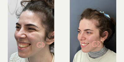 25-34 year old woman treated with Lip Repositioning, Botox for Gummy Smile - Lip repositioning surgery is the most effective method for gummy smile correction. It is usually a permanent procedure and after this surgery you won't need botox for your excessive gum visibility anymore. Lip repositioning surgery not only eliminates gingival visibility, but also reduces the wrinkles of the face and provides botox effect on the face by blocking overactive inner lip muscles. The healing process takes approximately 1 week and it takes approximately 1 month for the results to be fully established.