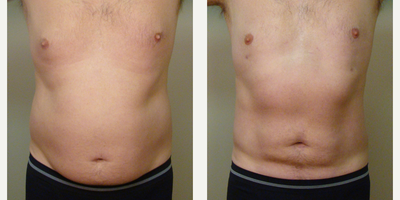 45-54 year old male treated with Aqualipo liposuction - This 51-year old male was unhappy with flab around midsection despite regular exercise, as well as his male breasts. Aqualipo, combining Body Jet and SmartLipo, to the abdomen, love handles, and chest gave him nice 8-week post-op results.