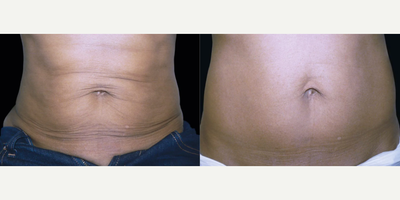 Woman treated with Exilis - Woman treated with Exilis