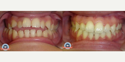 Woman treated with Braces - Our patient had a crossbite on her back teeth on the right side (when the upper teeth are inside of the lower teeth), an open bite on her front teeth, and the center lines of her top and bottom teeth (aka midlines) were not aligned. We were able to close her bite and correct the crossbite all with braces alone! Because her tongue has a habit of thrusting forward we made her a special retainer that has a tongue crib that she will wear at night to prevent her tongue from pushing those teeth back out to where they started.