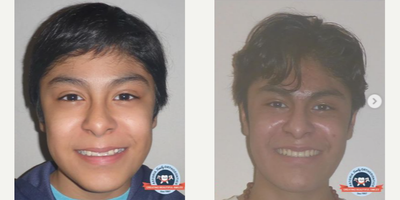 Man treated with Braces - Our patient came to us with a crossbite in the front and the back (when the upper teeth are inside of the lower teeth) and an asymmetric bite (center lines of teeth dont line up with each other or the face)!. In order to widen his upper arch we used an expander where he turned a key once a night until we got enough width and then we followed that up with a facemask that brings the upper jaw forward to correct his underbite. After we got enough correction side to side and front and back we finished off with braces top and bottom to create this finish! On this slide youll see before and after of hisresults as well as the appliances used along with the braces to achieve this result!