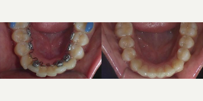 Woman treated with Braces - Want invisible braces?? Here is one of our finished InBrace patient. Inbrace is a set of braces behind the teeth.