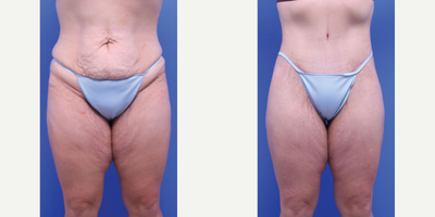 35-44 year old woman treated with Butt Lift, Tummy Tuck, Liposuction - Belt Lift (Butt Lift and Abdominoplasty), Liposuction of back, Fat transfer to buttocks
