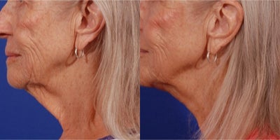 65-74 year old woman treated with Neck Lift - At age 70, this patient chose to undergo a Direct Neck Lift in Tucson to get a refreshed look for her forthcoming family reunion. The aging process left the skin around her neck lacking firmness and elasticity, which this innovative procedure can rectify. Now, the transformation seen in the before and after pictures testifies to the dramatic yet natural-looking improvement the Direct Neck Lift provided.Her sagging skin and any signs of excess fat were skillfully removed during the procedure. The result? A refined, sculpted look that surpassed her expectations. The patient's confidence is significantly boosted, and she now looks forward to her family reunion with a renewed sense of self-assurance.