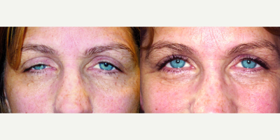 52 year old woman treated with Ptosis Surgery - Ptosis repair on 52 year old female