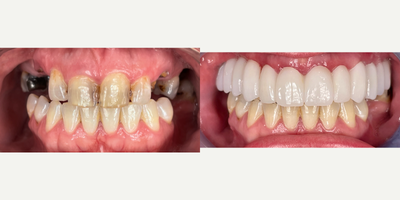 35-44 year old woman treated with Mini Dental Implants and cemented Porcelain Upper Roundhouse - Patient came in with missing teeth and decay. Completed extractions, removed infected gum tissue, placed mini dental implants on upper, let heal for a few weeks, cemented in final upper porcelain roundhouse. Bottom teeth were savable.