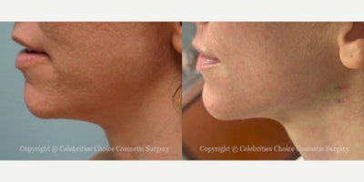 35-44 year old woman treated with NovaThreads - This patient had Novathread neck lift