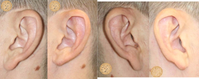 35-44 year old man treated with Ear Lobe Surgery - This gentleman has a family history  of long earlobes.