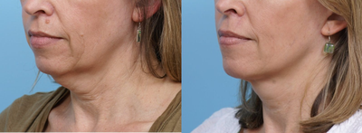 45-54 year old woman treated with SMAS Facelift - Note improvement in jowls, neck and marionette lines