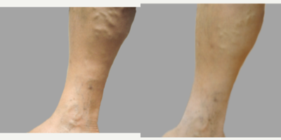 25-34 year old woman treated with VenaSeal - Treatment for chronic venous insufficiency.