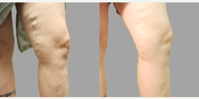 25-34 year old woman treated with VenaSeal - Treatment for chronic venous insufficiency.