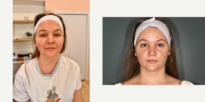 25-34 year old woman treated with IPL, Spironolactone For Acne - Female patient with acne and post-acne before and after ONE IPL treatment and topical regimen.