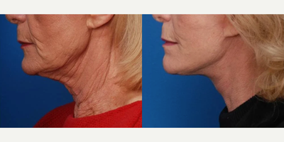 55-64 year old woman treated with Neck Lift - This patient had significant sun exposure in youth and current concerns of excessive aging in the neck region. She underwent a neck lift to create a more natural and elegant neck and neckline